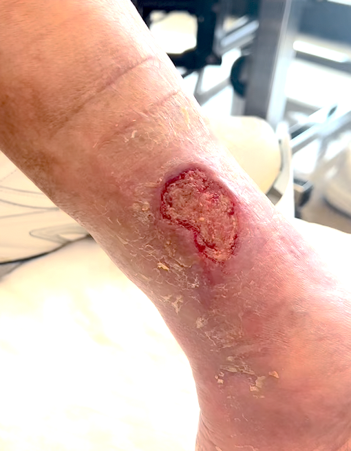 softkcot case1 after